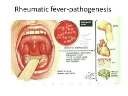 Ảnh 1 của Rheumatic fever